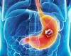 Rakovina žaludku: jak se chová na jevišti I?