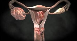 5 časné příznaky rakoviny děložního čípku