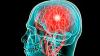 6 časné příznaky cévní mozkové příhody