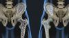 Proč vápníku by neměly být brány na osteoporózu? Celá pravda o vápník, a jak udržet kostní tkáně v dobrém stavu