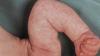 "Mramorová" kůže u kojenců: norma nebo patologie? Neurolog odpovídá