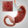 Gastritidu nebo eroze žaludku: hlavní příznaky, léčba, dieta