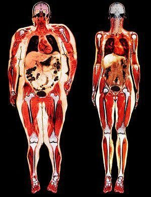 Vlevo - právě viscerální obezita. Všechny orgány přikrytý s tukem.