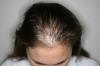 Plešatost u žen. Parse otázka AGA a které léky se doporučuje trichologists