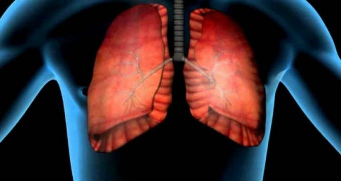 rakovina plic