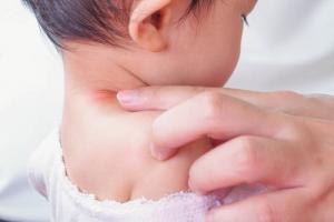 Pásový opar je dítě: zdroje infekce, příznaky a léčba
