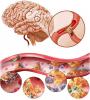 Mozková ateroskleróza: jak se chovat, jaké jsou příznaky?