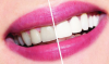 Jak bělení zubů doma? zubní rada.