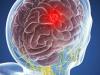 Nádory mozku: 5 symptomy, které nemůže být ignorována