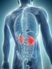 Rakoviny ledvin: časné příznaky, které by měly upozorní