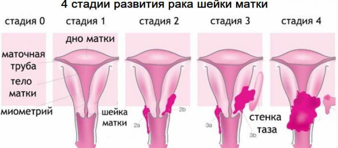 4 stádia rakoviny děložního čípku