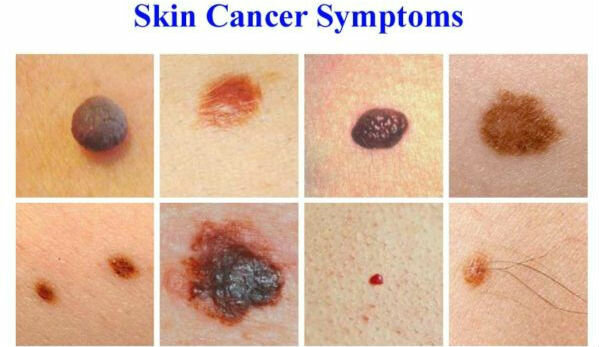 Příznaky rakoviny kůže