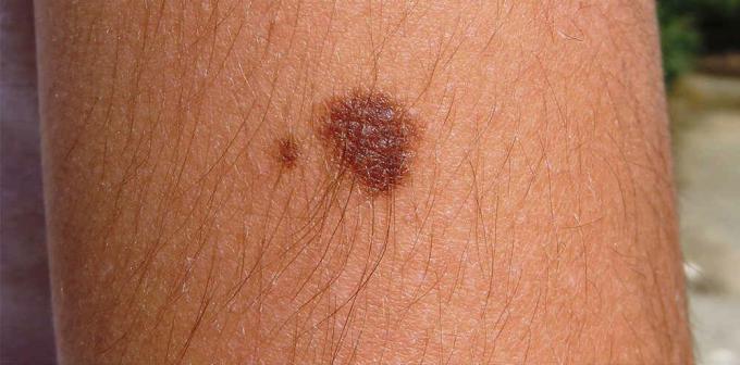 Kožní melanom počáteční fáze