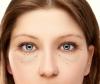 Jak se zbavit bez chirurgického zákroku, kýly a spodní víčko oka pytlů